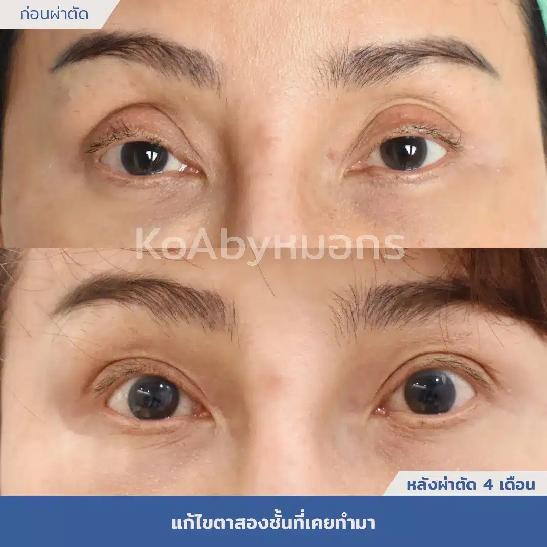 Revision Eyelid Surgery