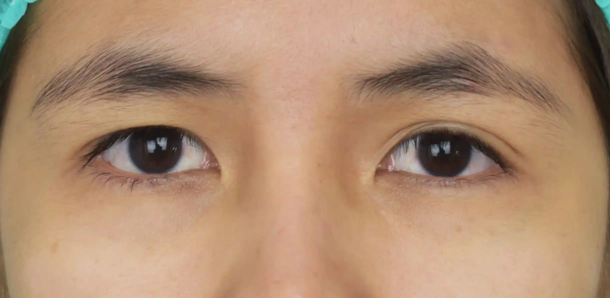 Uneven double store eyelid