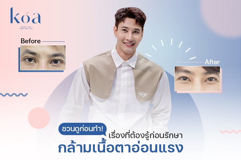 รักษา กล้าม เนื้อ ตา อ่อน แรง