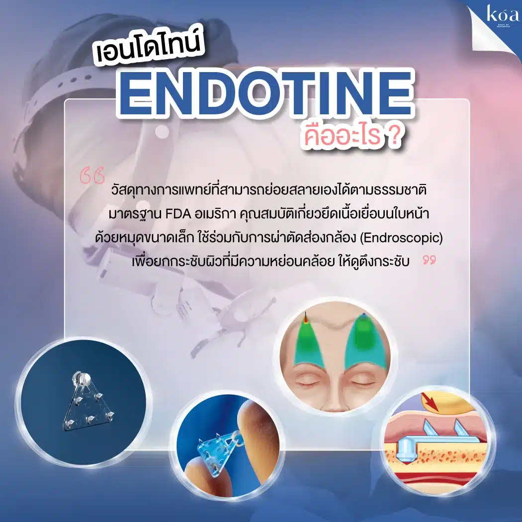 เอนโดไทน์ (Endotine) คืออะไร 