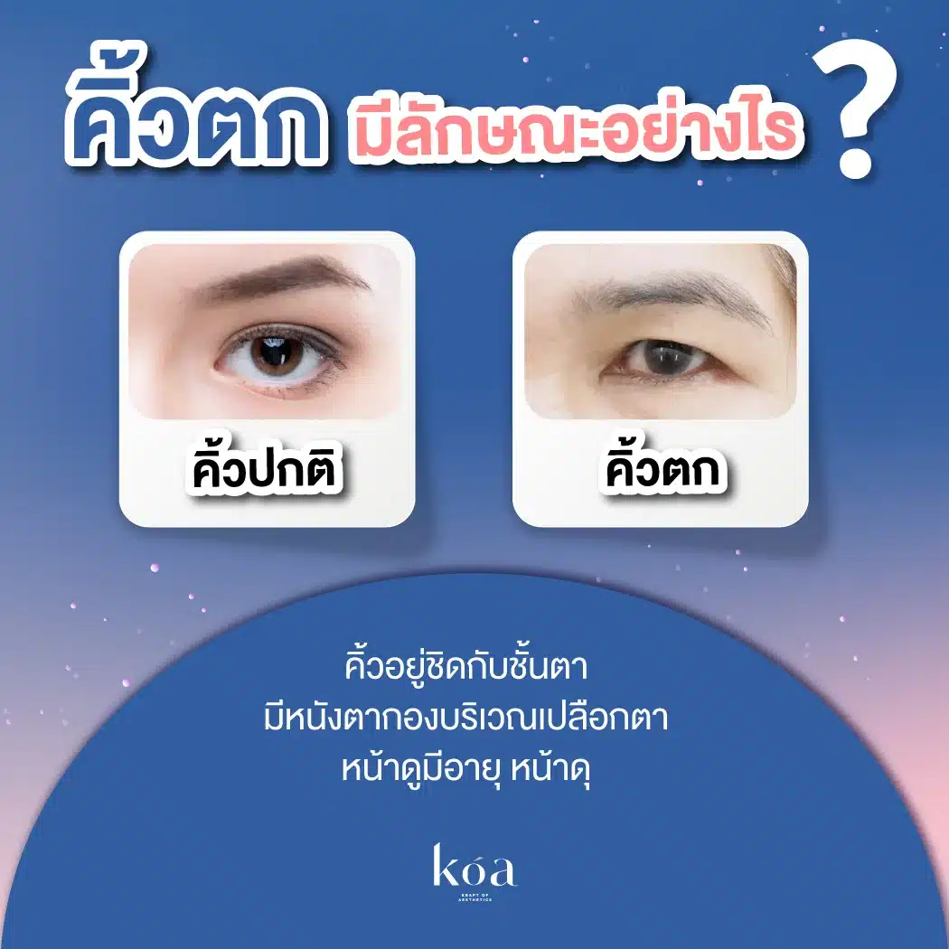 ทำไมคิ้วตกต้องแก้ด้วยการส่องกล้องยกคิ้วเอนโดไทน์